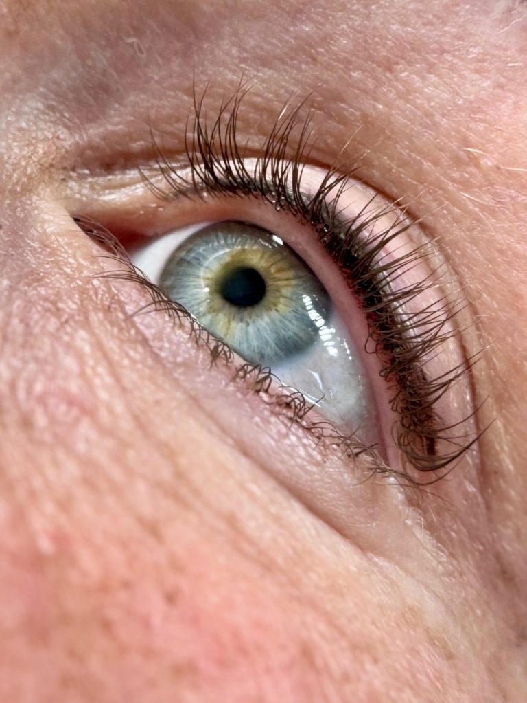 Wimpernkranzverdichtung Lindau
